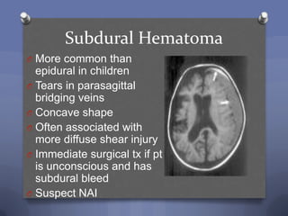 Subdural Hematoma
O More common than
  epidural in children
O Tears in parasagittal
  bridging veins
O Concave shape
O Often associated with
  more diffuse shear injury
O Immediate surgical tx if pt
  is unconscious and has
  subdural bleed
O Suspect NAI
 