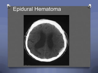 Epidural Hematoma
 