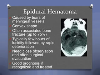 Epidural Hematoma
O Caused by tears of
  meningeal vessels
O Convex shape
O Often associated bone
  fracture (up to 75%)
O Typically few hours of
  lucidity followed by rapid
  deterioration
O Need close observation
  and often surgical
  evacuation
O Good prognosis if
  recognized and treated
 