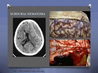 SUBDURAL HEMATOMA




 WebPath: University of Utah
 http://www-medlib.med.utah.edu
 
