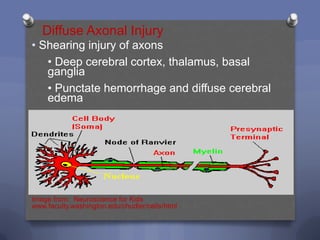 Diffuse Axonal Injury
• Shearing injury of axons
   • Deep cerebral cortex, thalamus, basal
   ganglia
   • Punctate hemorrhage and diffuse cerebral
   edema




Image from: Neuroscience for Kids
www.faculty.washington.edu/chudler/cells/html
 