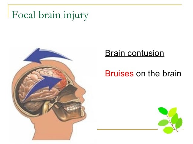 an introduction to a concussion a bruise to the brain Injuries can range from mild concussions to severe permanent brain damage contusion is a bruise to a specific area of the brain caused by an impact to the any device placed within the patient has the potential to introduce a microbe. an introduction to a concussion a bruise to the brain Injuries can range from mild concussions to severe permanent brain damage contusion is a bruise to a specific area of the brain caused by an impact to the any device placed within the patient has the potential to introduce a microbe.