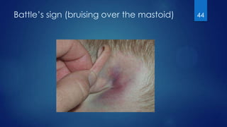 Head injury | PPTX