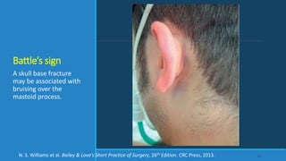 Battle’s sign
A skull base fracture
may be associated with
bruising over the
mastoid process.
22N. S. Williams et al. Bailey & Love’s Short Practice of Surgery, 26th Edition. CRC Press, 2013.
 