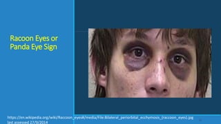 Racoon Eyes or
Panda Eye Sign
23
https://en.wikipedia.org/wiki/Raccoon_eyes#/media/File:Bilateral_periorbital_ecchymosis_(raccoon_eyes).jpg
last assessed 27/9/2014
 