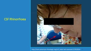 CSF Rhinorrhoea
24http://care.american-rhinologic.org/csf_leaks last assessed 27/9/2014
 