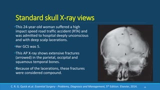 Standard skull X-ray views
•This 24-year-old woman suffered a high
impact speed road traffic accident (RTA) and
was admitted to hospital deeply unconscious
and with deep scalp lacerations.
•Her GCS was 5.
•This AP X-ray shows extensive fractures
(arrowed) in the parietal, occipital and
squamous temporal bones.
•Because of the lacerations, these fractures
were considered compound.
46C. R. G. Quick et.al. Essential Surgery - Problems, Diagnosis and Management, 5th Edition. Elsevier, 2014.
 
