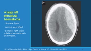 A large left
extradural
haematoma
•biconvex shape
•exerts a mass effect
•a smaller right acute
subdural haematoma is
also evident.
54N. S. Williams et al. Bailey & Love’s Short Practice of Surgery, 26th Edition. CRC Press, 2013.
 