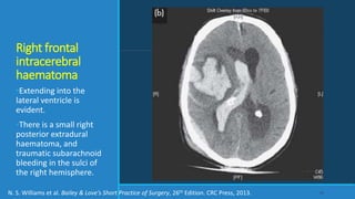 Right frontal
intracerebral
haematoma
•Extending into the
lateral ventricle is
evident.
•There is a small right
posterior extradural
haematoma, and
traumatic subarachnoid
bleeding in the sulci of
the right hemisphere.
56N. S. Williams et al. Bailey & Love’s Short Practice of Surgery, 26th Edition. CRC Press, 2013.
 