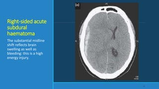 Right-sided acute
subdural
haematoma
The substantial midline
shift reflects brain
swelling as well as
bleeding: this is a high
energy injury.
59
 