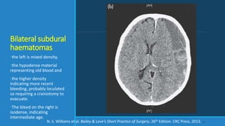 Bilateral subdural
haematomas
•the left is mixed density,
•the hypodense material
representing old blood and
•the higher density
indicating more recent
bleeding, probably loculated
so requiring a craniotomy to
evacuate.
•The bleed on the right is
isodense, indicating
intermediate age.
60N. S. Williams et al. Bailey & Love’s Short Practice of Surgery, 26th Edition. CRC Press, 2013.
 