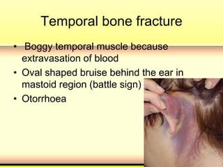 Temporal bone fracture
• Boggy temporal muscle because
extravasation of blood
• Oval shaped bruise behind the ear in
mastoid region (battle sign)
• Otorrhoea
 