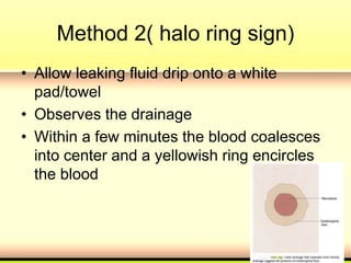Method 2( halo ring sign)
• Allow leaking fluid drip onto a white
pad/towel
• Observes the drainage
• Within a few minutes the blood coalesces
into center and a yellowish ring encircles
the blood
 