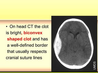 • On head CT the clot
is bright, biconvex
shaped clot and has
a well-defined border
that usually respects
cranial suture lines
 