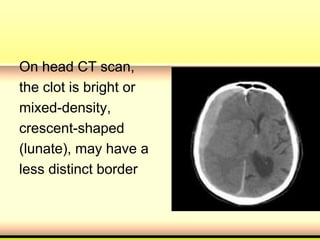 On head CT scan,
the clot is bright or
mixed-density,
crescent-shaped
(lunate), may have a
less distinct border
 