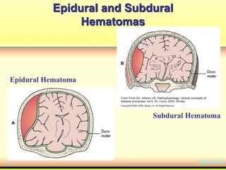 Epidural and Subdural
Hematomas
Fig. 55-15
Epidural Hematoma
Subdural Hematoma
 