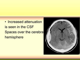 • Increased attenuation
is seen in the CSF
Spaces over the cerebral
hemisphere
 