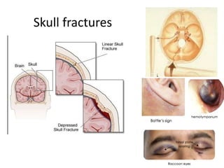 Head injury( Diagnosis/symptoms/investigation/Treatment) | PPTX