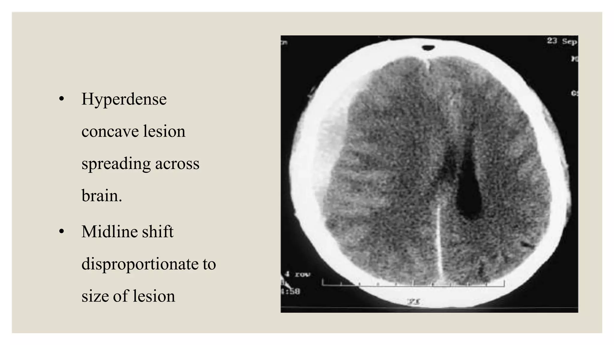 Primary and secondary head injury EDH and SDH | PPTX