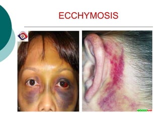ECCHYMOSIS
 