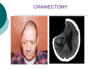 CRANIECTOMY
 