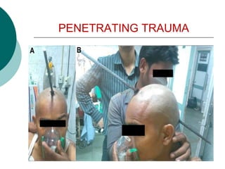 PENETRATING TRAUMA
 