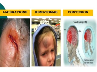 LACERATIONS HEMATOMAS CONTUSION
 