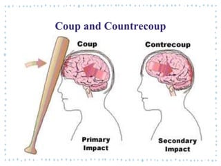 Coup and Countrecoup
 