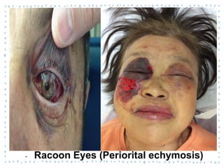 ‐ Racoon Eyes (Periorital echymosis)
 