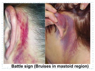 ‐ Battle sign (Bruises in mastoid region)
 
