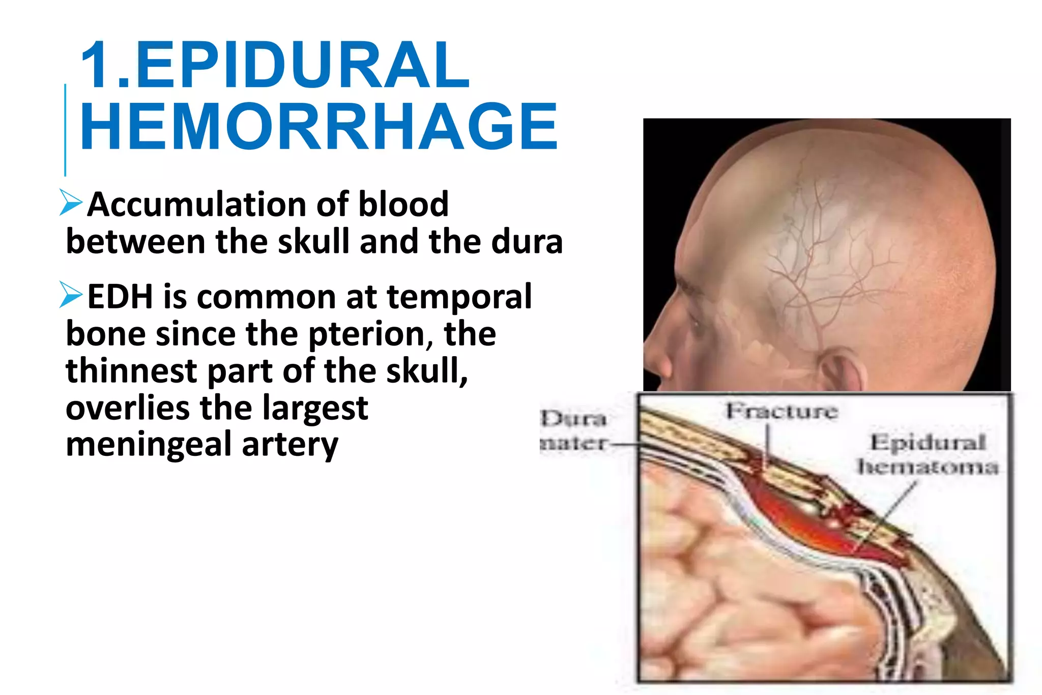Head Emems Head injury | PPTX