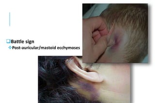 Battle sign
Post-auricular/mastoid ecchymoses
 