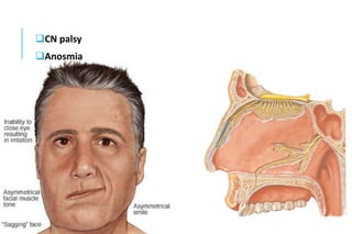 CN palsy
Anosmia
 