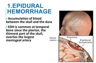 1.EPIDURAL
HEMORRHAGE
Accumulation of blood
between the skull and the dura
EDH is common at temporal
bone since the pterion, the
thinnest part of the skull,
overlies the largest
meningeal artery
 