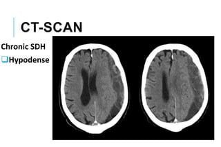 CT-SCAN
Chronic SDH
Hypodense
 