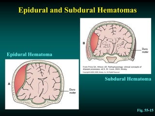 Epidural and Subdural Hematomas
Fig. 55-15
Epidural Hematoma
Subdural Hematoma
 