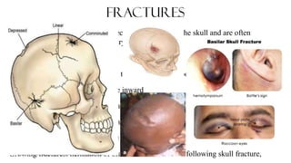 Skull Potential Injuries Head Injury in children and its prevention.pptx