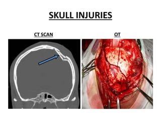 SKULL INJURIES
CT SCAN OT
 