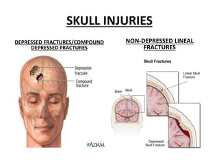 SKULL INJURIES
DEPRESSED FRACTURES/COMPOUND
DEPRESSED FRACTURES
NON-DEPRESSED LINEAL
FRACTURES
 