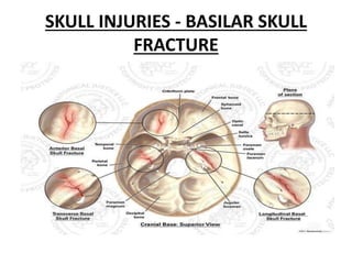 SKULL INJURIES - BASILAR SKULL
FRACTURE
 