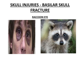 SKULL INJURIES - BASILAR SKULL
FRACTURE
RACCOON EYE
 