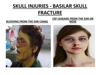 SKULL INJURIES - BASILAR SKULL
FRACTURE
BLEEDING FROM THE EAR CANAL
CSF LEAKAGE FROM THE EAR OR
NOSE
 