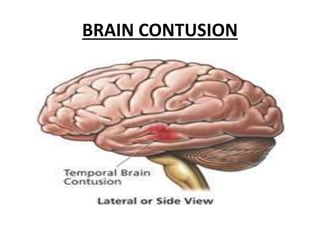 BRAIN CONTUSION
 