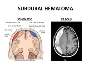 SUBDURAL HEMATOMA
SCHEMATIC CT SCAN
 