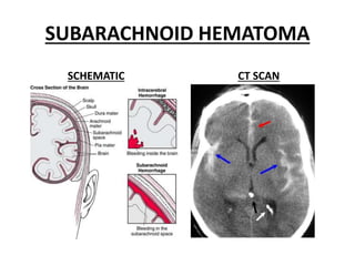 SUBARACHNOID HEMATOMA
SCHEMATIC CT SCAN
 