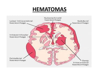 HEMATOMAS
 