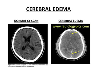 CEREBRAL EDEMA
NORMAL CT SCAN CEREBRAL EDEMA
 