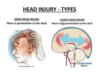 HEAD INJURY - TYPES
OPEN HEAD INJURY:
There is penetration to the skull.
CLOSED HEAD INJURY
There is NO penetration to the skull.
 