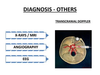 DIAGNOSIS - OTHERS
X-RAYS / MRI
ANGIOGRAPHY
EEG
TRANSCRANIAL DOPPLER
 