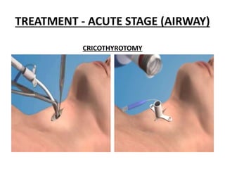 TREATMENT - ACUTE STAGE (AIRWAY)
CRICOTHYROTOMY
 